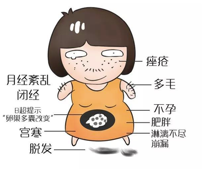 多囊卵巢综合征